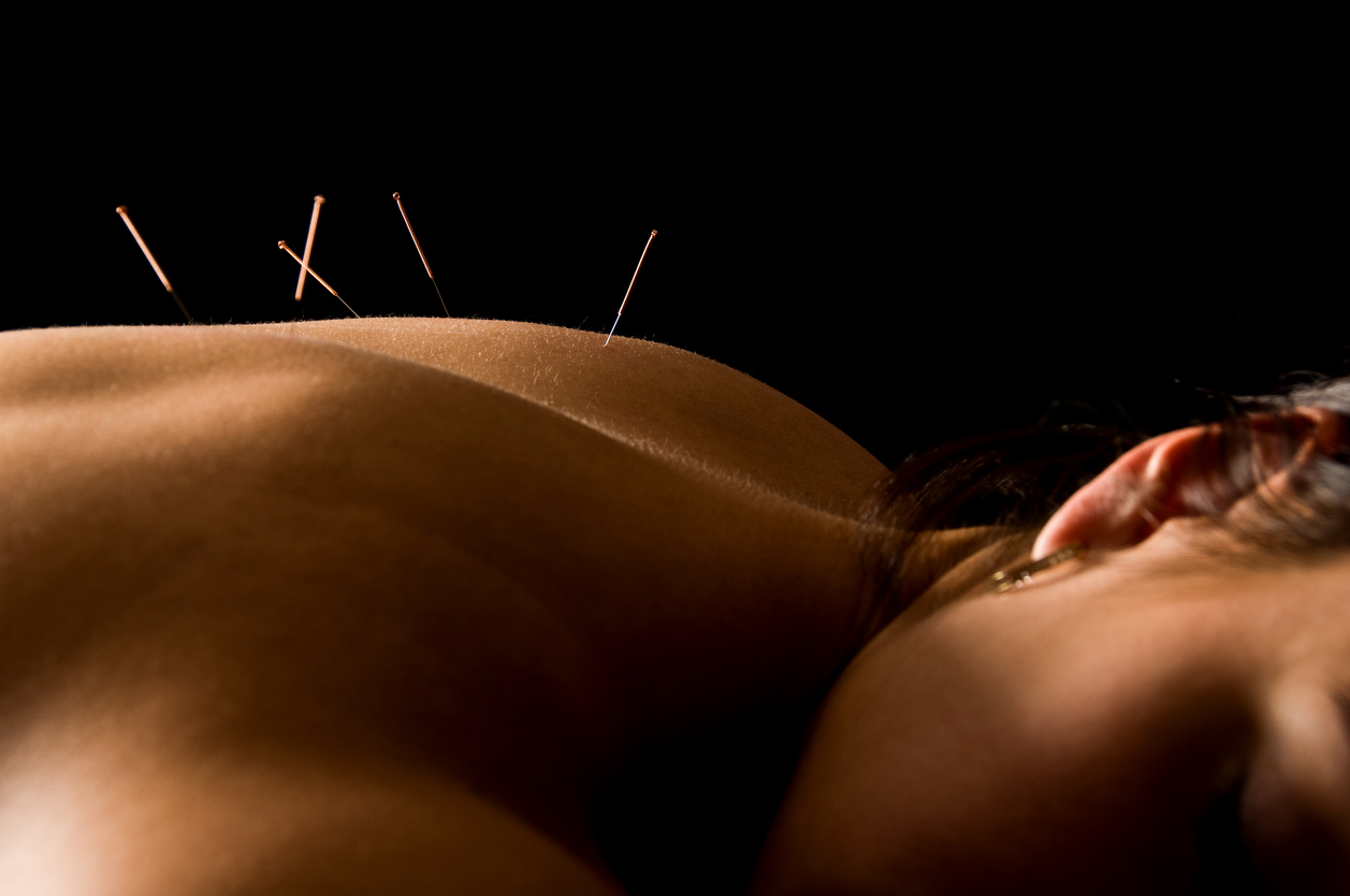 Acupuncture needles on a client back