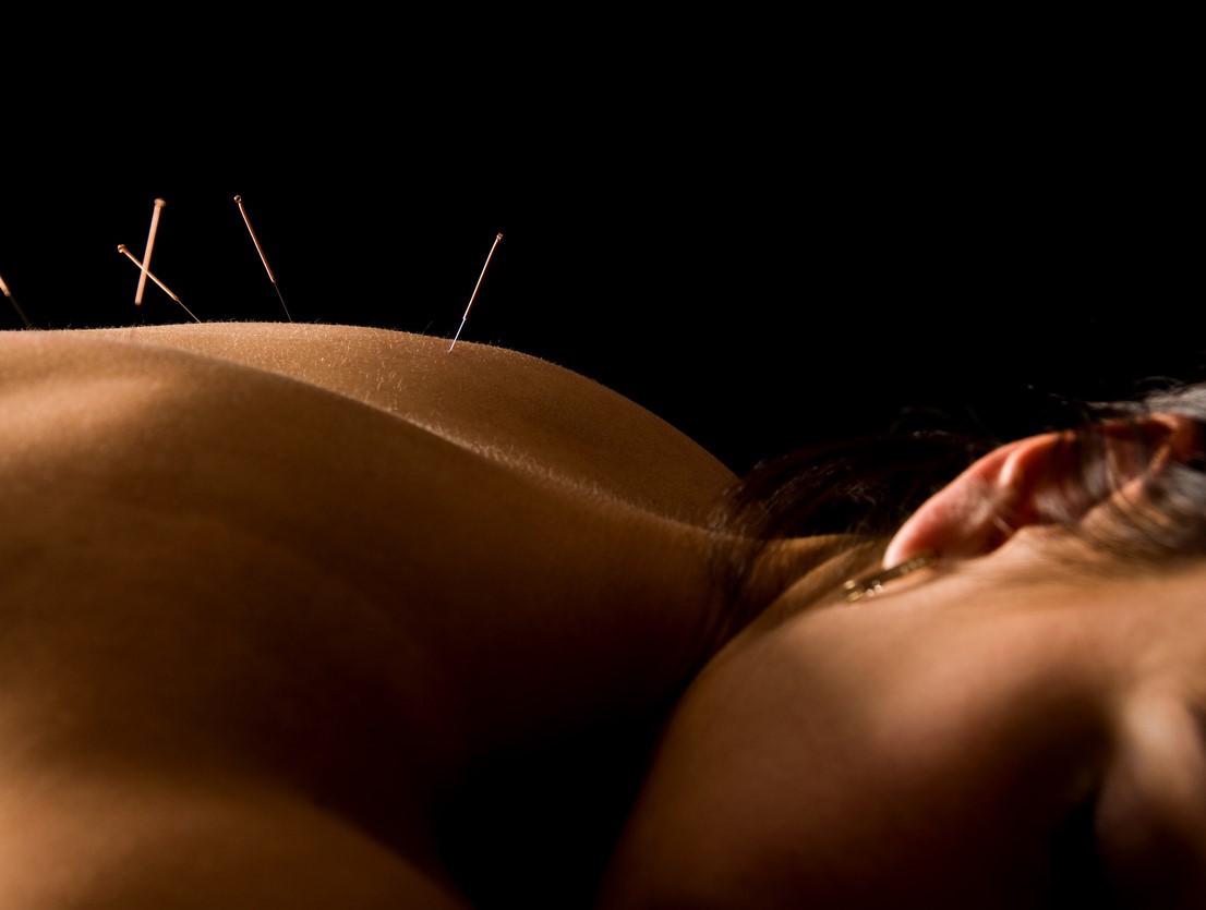 Acupuncture needles on a client's back
