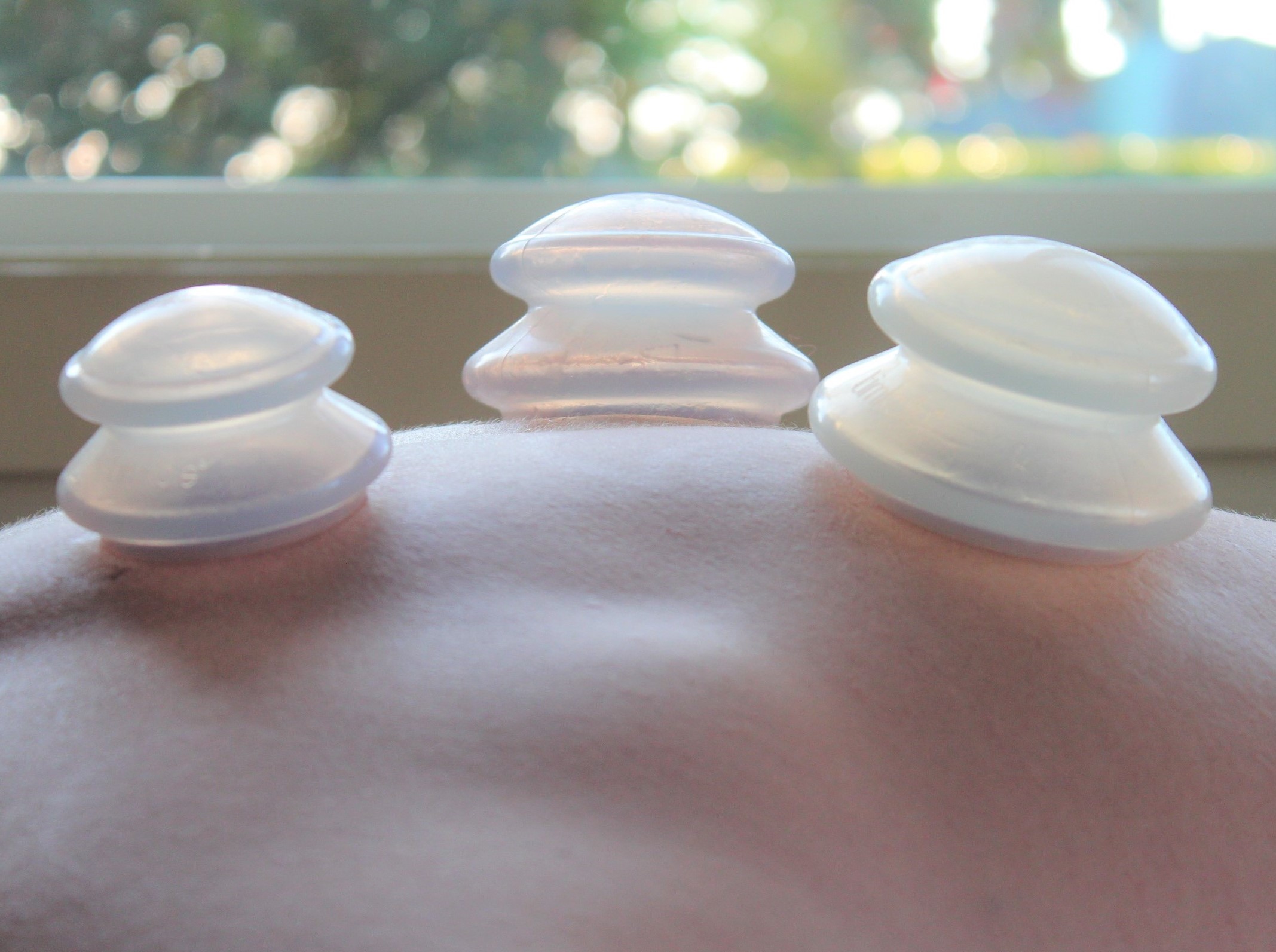 Orthopedic cups on a back