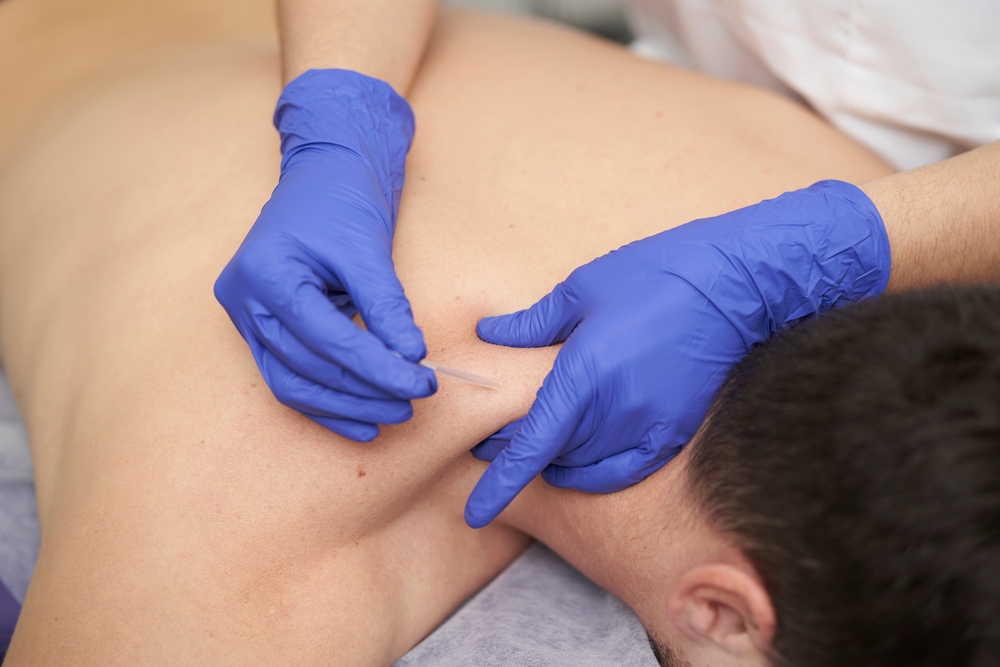 Dry needling for neck pain Dry needling for neck pain