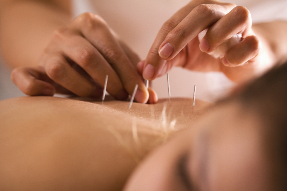 Acupuncture Acupuncture