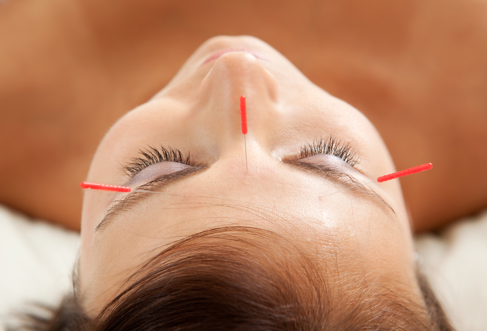 Cosmetic acupuncture Cosmetic acupuncture